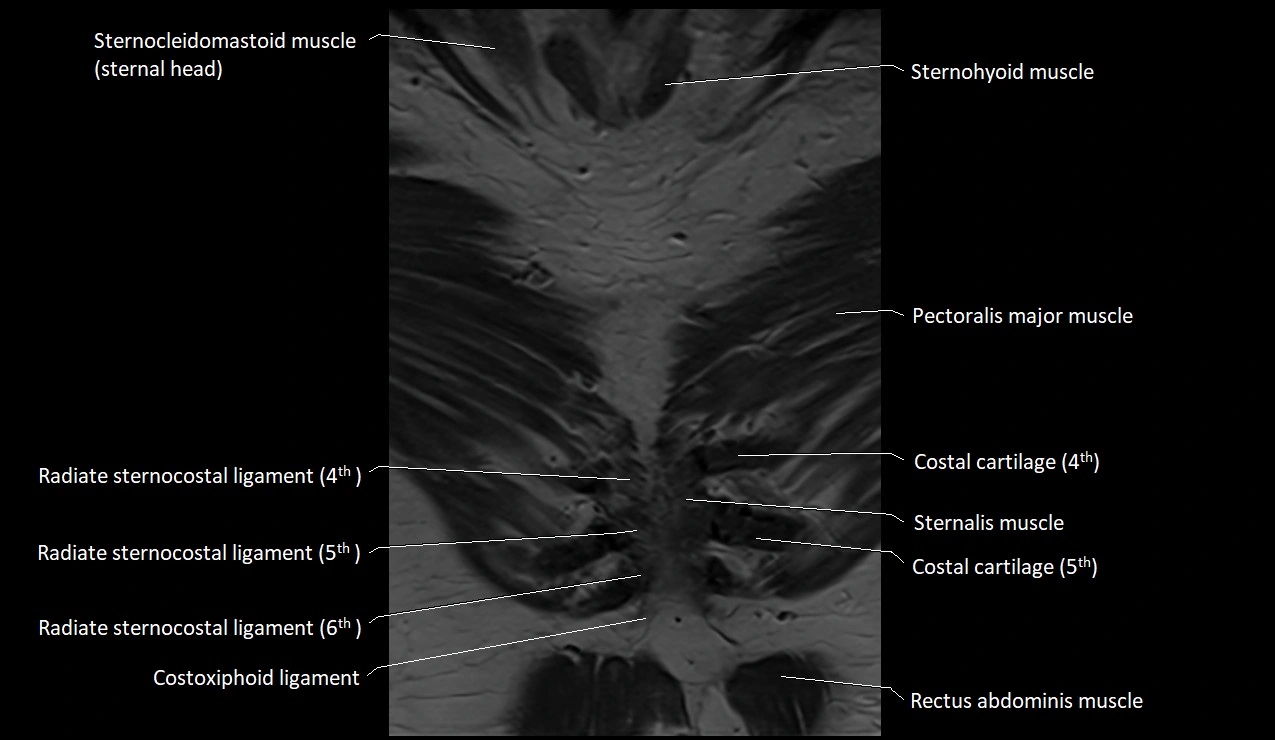 MRI sternum and sternoclavicular joint labeled coronal anatomy image 4.webp